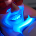 Sbiancamento professionale o fai da te? Quali sono i risultati sul nostro sorriso?