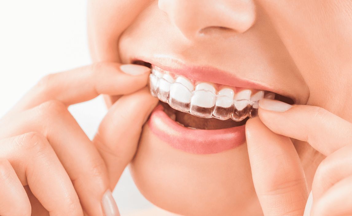 Applicazione di un allineatore trasparente per ortodonzia invisibile