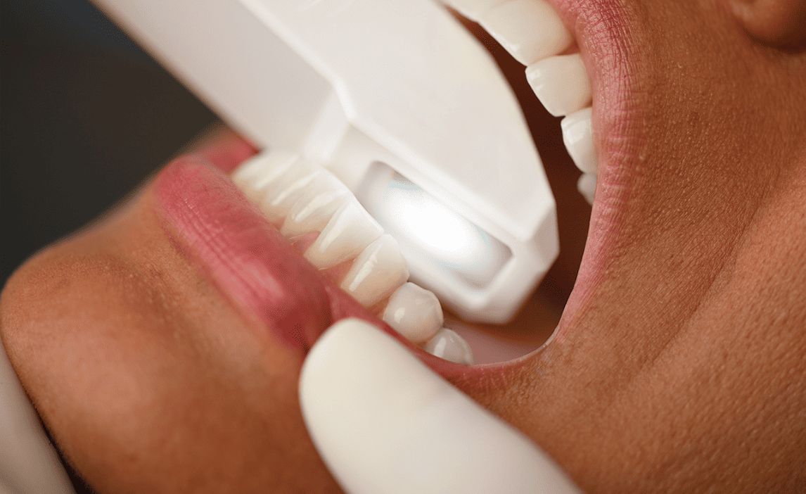 Seduta di igiene dentale professionale allo Studio Recchia Odontoiatri